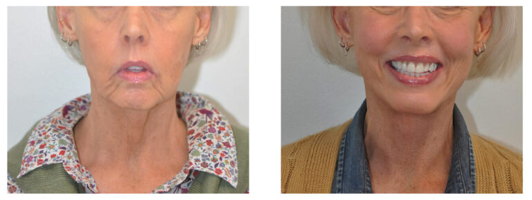 A patient's face before and after a facelift surgery.