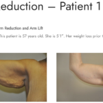 Arm Lift - Image 4