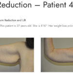 Arm Lift - Image 3