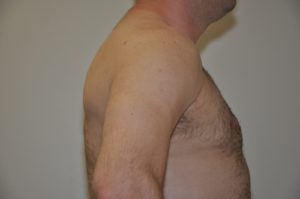 Patient 1 - Mastectomy and Liposuction After Side