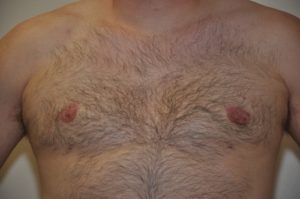 Patient 1 - Mastectomy and Liposuction Front After