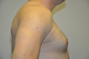 Patient 1 - Mastectomy and Liposuction Side Before