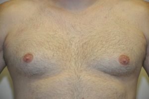 Patient 1 - Mastectomy and Liposuction Front Before