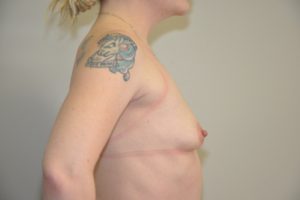 Patient 12 - Breast Augmentation with Implants Before