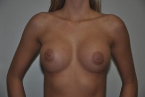 Patient 14 - Breast Augmentation with Implants After