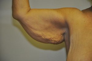 Patient 1 - Arm Reduction/Lift Before