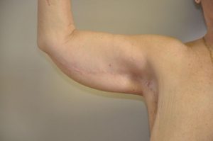 Patient 1 - Arm Reduction/Lift After