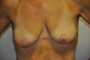 Patient 1 - Breast Lift Before