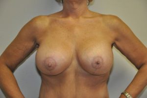 Patient 1 - Breast Lift After