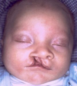 Patient 1 - Cleft Lip Palate Before