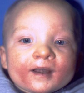 Patient 1 - Cleft Lip Palate After