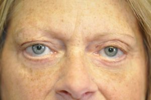 Patient 1 - Eyelids After