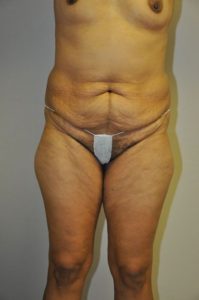 Patient 1 - Liposuction Before