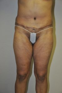 Patient 1 - Liposuction After