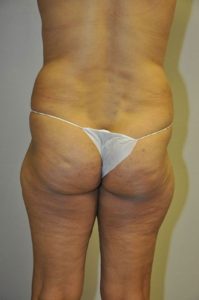 Patient 1 - Liposuction Before