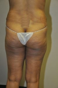 Patient 1 - Liposuction After