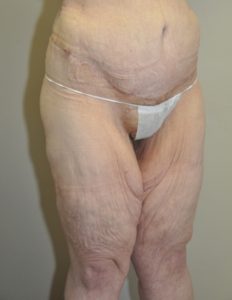Patient 6 - Massive Weight Loss Buttock Lift After Side Front