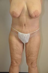 Patient 1 - Thigh Lift and Tummy Tuck After