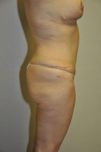 Patient 1 - Tummy Tuck After