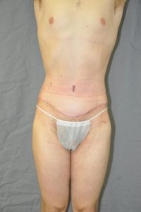 Patient 1 - Tummy Tuck After
