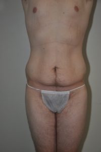 Patient 1 - Tummy Tuck Before