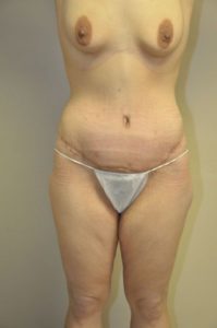 Patient 1 - Tummy Tuck Following Large Weight Loss After