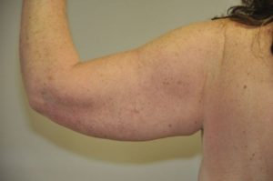 Patient 2 - Arm Reduction/Lift Before