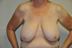 Patient 2 - Breast Reduction Before