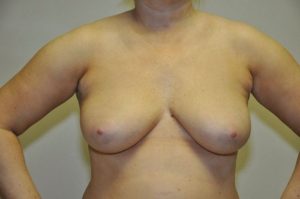Patient 2 - Breast Augmentation with Implants Before