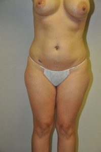 Patient 2 - Liposuction Before