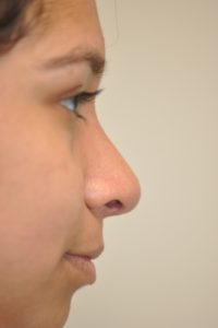 Patient 2 - Nose After