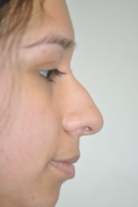 Patient 2 - Nose Before