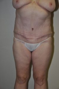 Patient 2 - Tummy Tuck After