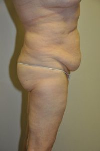 Patient 2 - Tummy Tuck Before