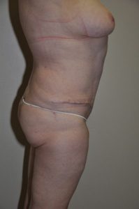 Patient 2 - Tummy Tuck After