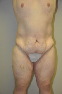 Patient 2 - Tummy Tuck Following Large Weight Loss Before
