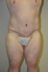 Patient 2 - Tummy Tuck Following Large Weight Loss After