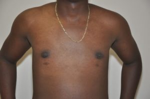 Patient 2 - Mastectomy and Liposuction After Front