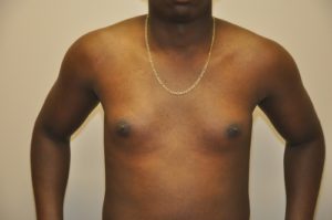 Patient 2 - Mastectomy and Liposuction Before Front