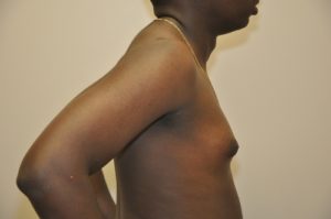 Patient 2 - Mastectomy and Liposuction Before Side