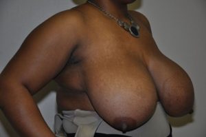 Patient 3 - Breast Reduction Before