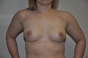 Patient 3 - Breast Augmentation with Implants Before