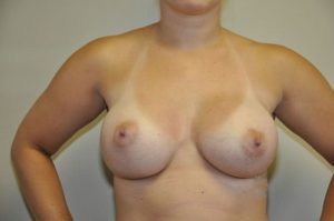 Patient 3 - Breast Augmentation with Implants After