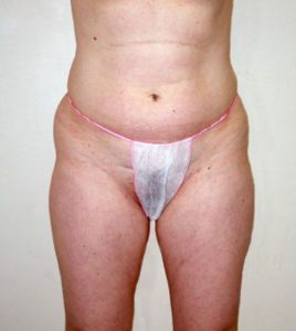 Patient 3 - Liposuction Before