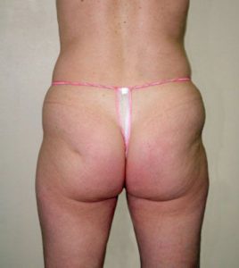 Patient 3 - Liposuction Before