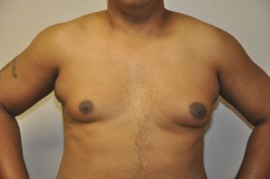 Patient 3 - Mastectomy and Liposuction Before Front