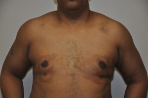 Patient 3 - Mastectomy and Liposuction After Front