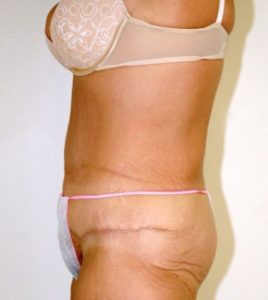 Patient 3 - Tummy Tuck Following Large Weight Loss After