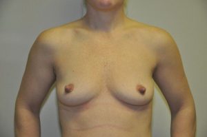 Patient 4 - Breast Augmentation with Implants Before
