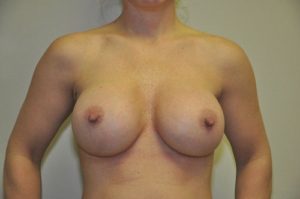 Patient 4 - Breast Augmentation with Implants After